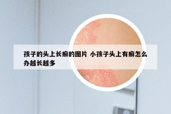 孩子的头上长癣的图片 小孩子头上有癣怎么办越长越多