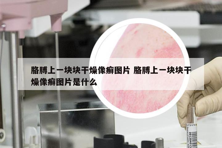 胳膊上一块块干燥像癣图片 胳膊上一块块干燥像癣图片是什么