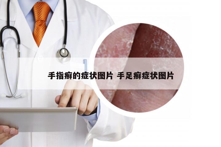 手指癣的症状图片 手足癣症状图片