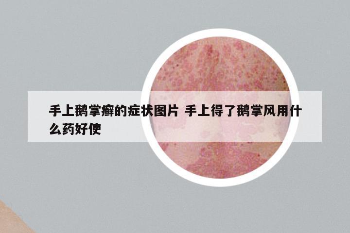 手上鹅掌癣的症状图片 手上得了鹅掌风用什么药好使