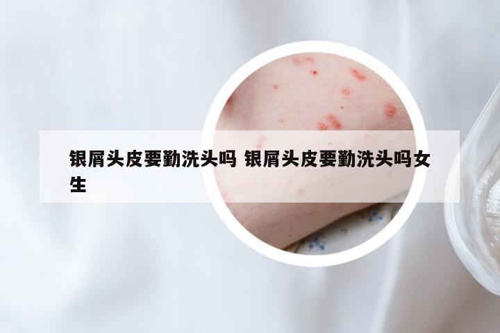 银屑头皮要勤洗头吗 银屑头皮要勤洗头吗女生