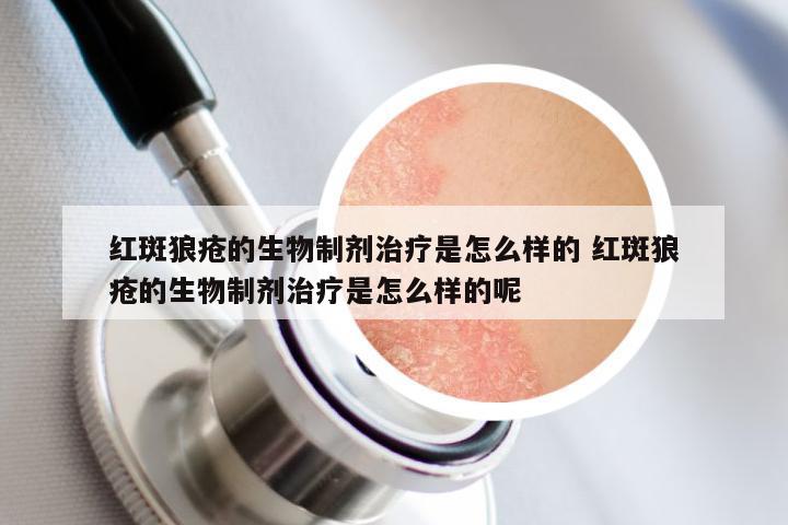 红斑狼疮的生物制剂治疗是怎么样的 红斑狼疮的生物制剂治疗是怎么样的呢