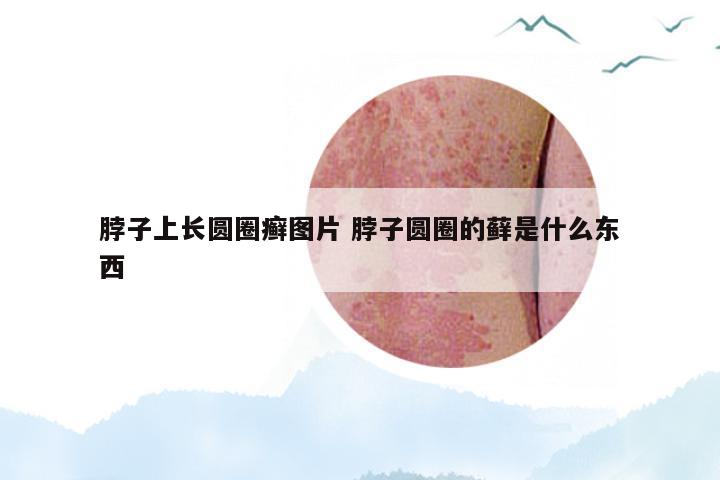 脖子上长圆圈癣图片 脖子圆圈的藓是什么东西