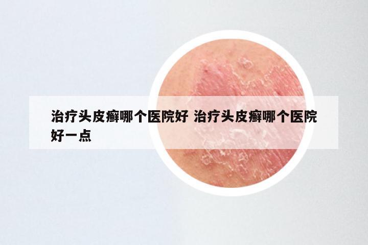 治疗头皮癣哪个医院好 治疗头皮癣哪个医院好一点