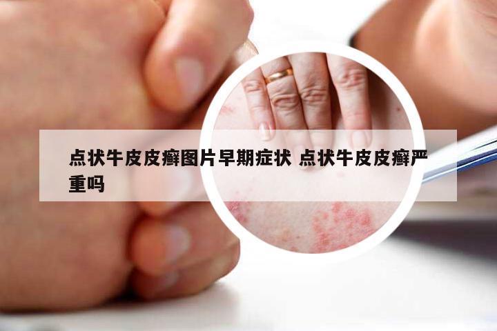 点状牛皮皮癣图片早期症状 点状牛皮皮癣严重吗