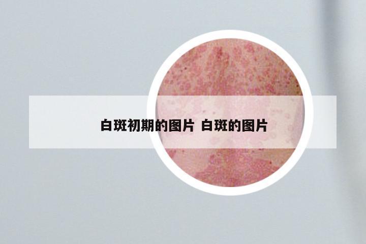 白斑初期的图片 白斑的图片