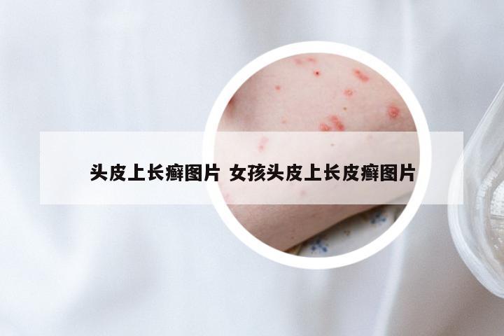 头皮上长癣图片 女孩头皮上长皮癣图片