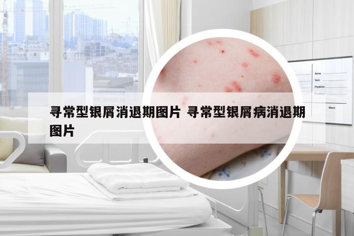 寻常型银屑消退期图片 寻常型银屑病消退期图片