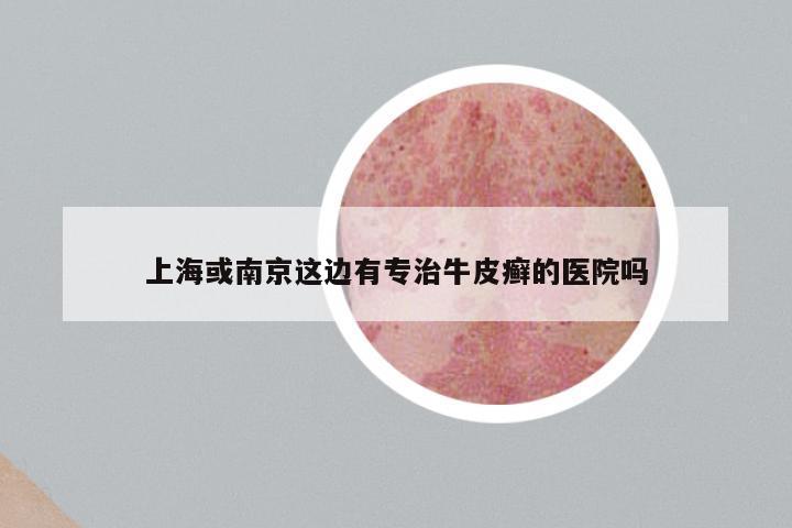 上海或南京这边有专治牛皮癣的医院吗