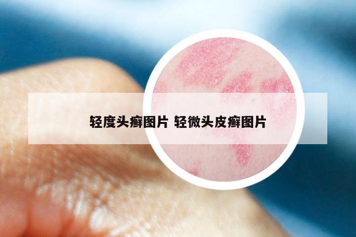 轻度头癣图片 轻微头皮癣图片