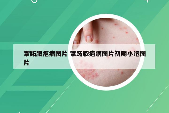 掌跖脓疱病图片 掌跖脓疱病图片初期小泡图片