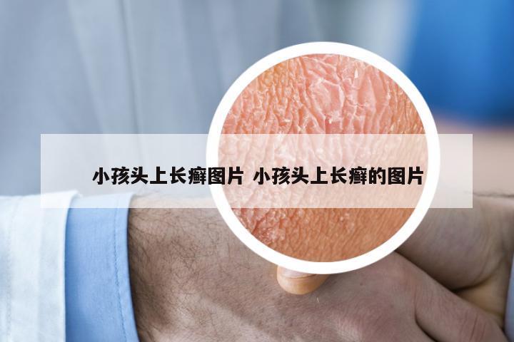 小孩头上长癣图片 小孩头上长癣的图片