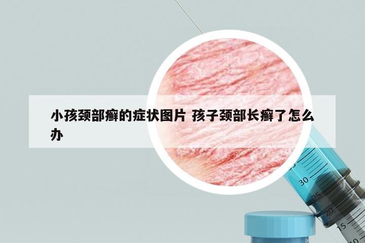 小孩颈部癣的症状图片 孩子颈部长癣了怎么办