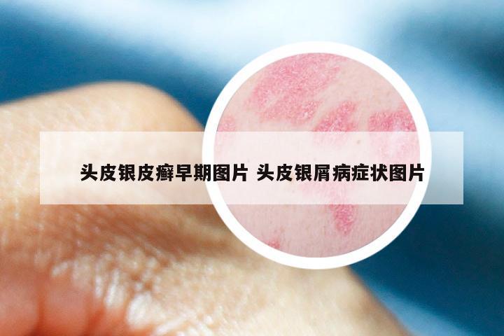 头皮银皮癣早期图片 头皮银屑病症状图片