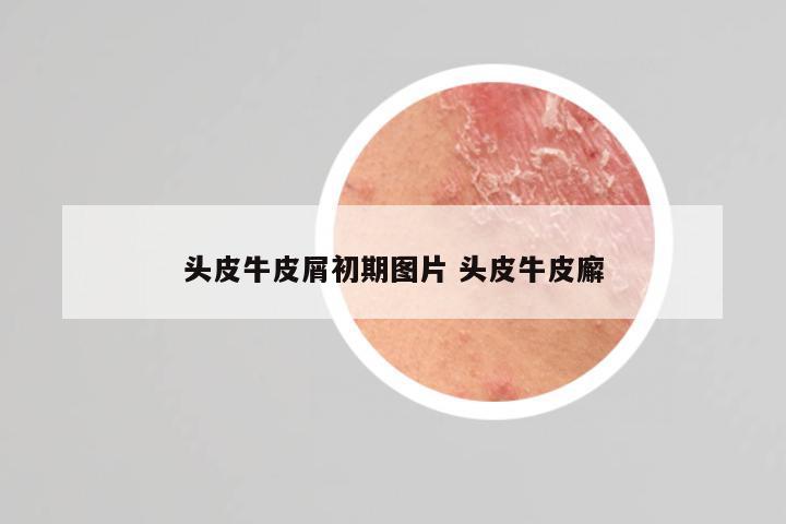 头皮牛皮屑初期图片 头皮牛皮廨