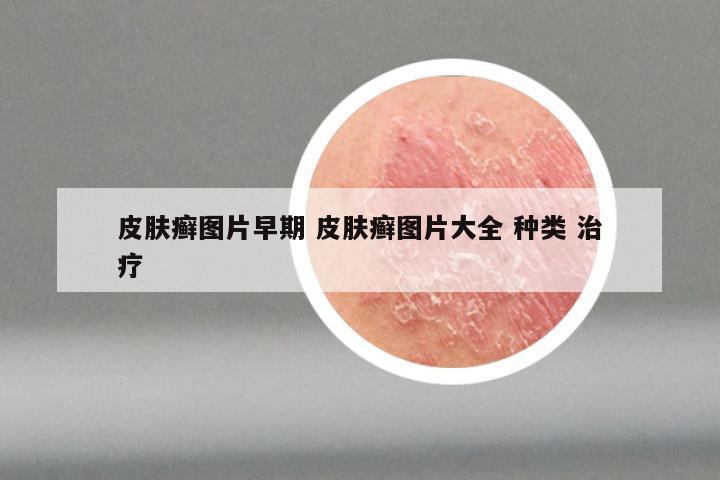 皮肤癣图片早期 皮肤癣图片大全 种类 治疗