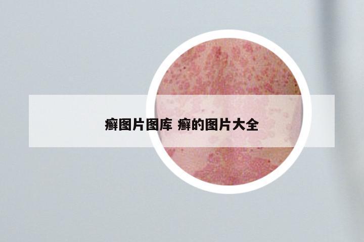 癣图片图库 癣的图片大全