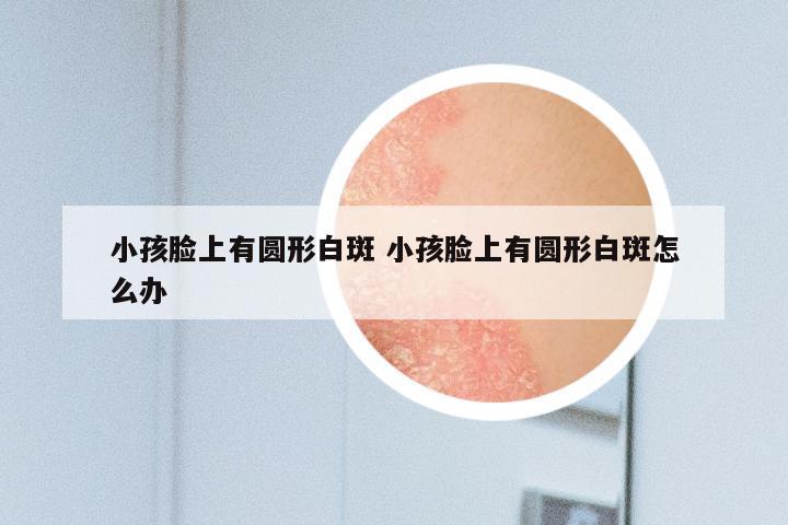 小孩脸上有圆形白斑 小孩脸上有圆形白斑怎么办