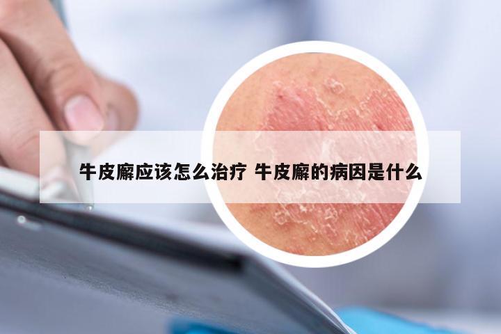 牛皮廨应该怎么治疗 牛皮廨的病因是什么