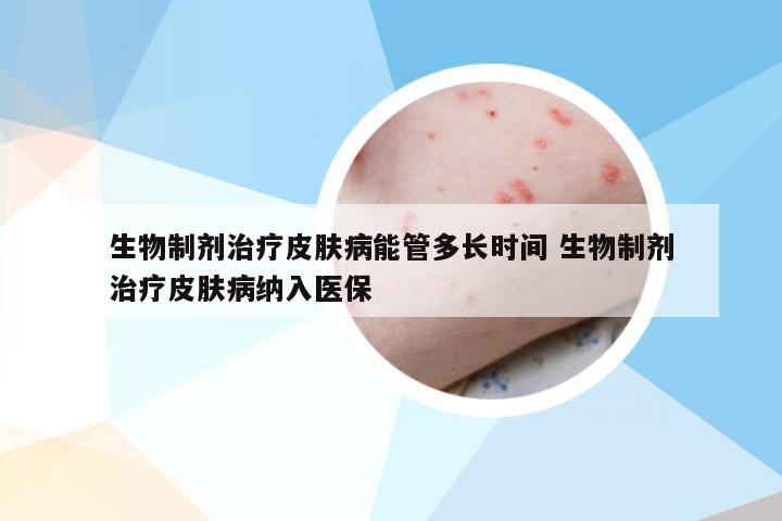 生物制剂治疗皮肤病能管多长时间 生物制剂治疗皮肤病纳入医保