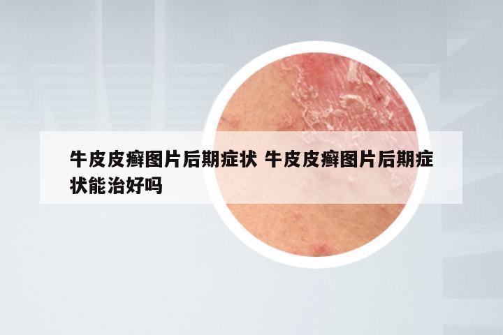 牛皮皮癣图片后期症状 牛皮皮癣图片后期症状能治好吗