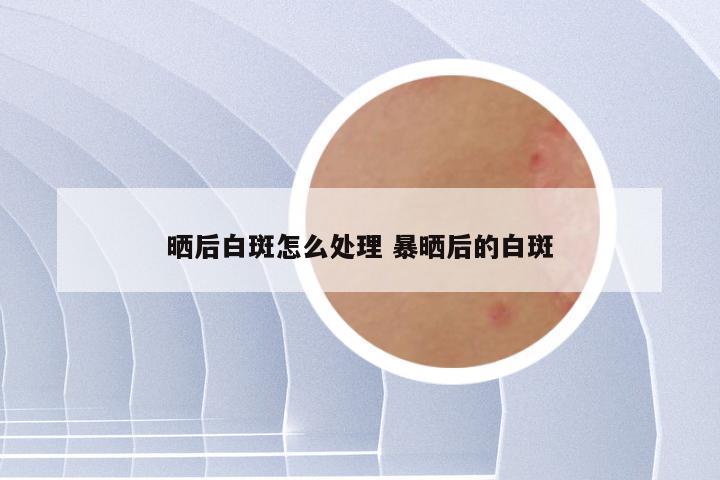 晒后白斑怎么处理 暴晒后的白斑