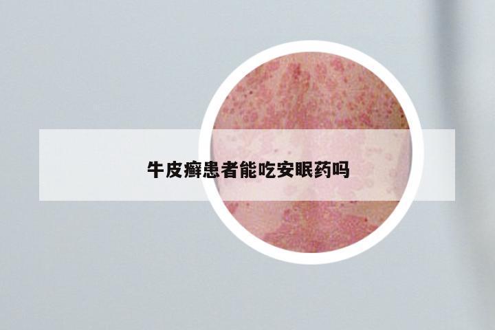 牛皮癣患者能吃安眠药吗