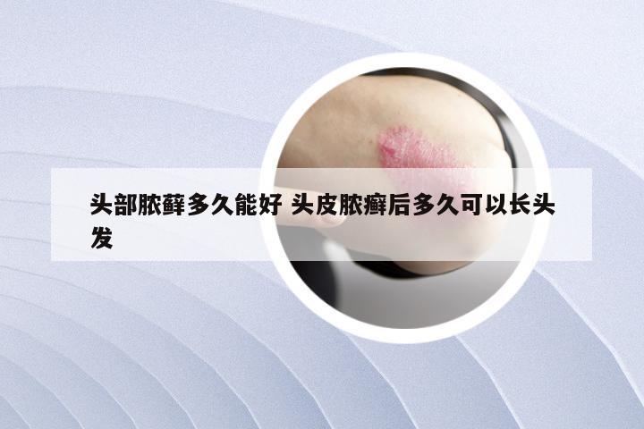 头部脓藓多久能好 头皮脓癣后多久可以长头发