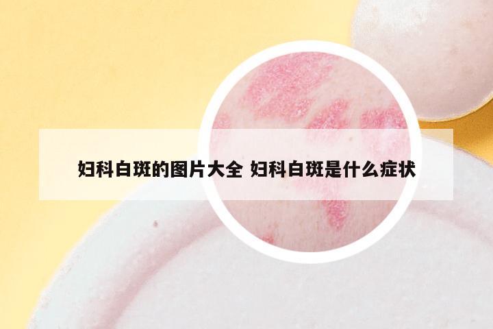 妇科白斑的图片大全 妇科白斑是什么症状