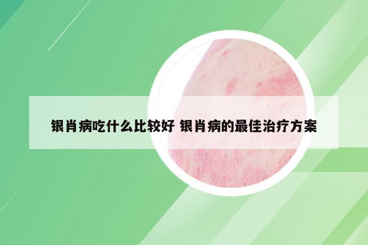 银肖病吃什么比较好 银肖病的最佳治疗方案