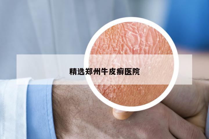 精选郑州牛皮癣医院