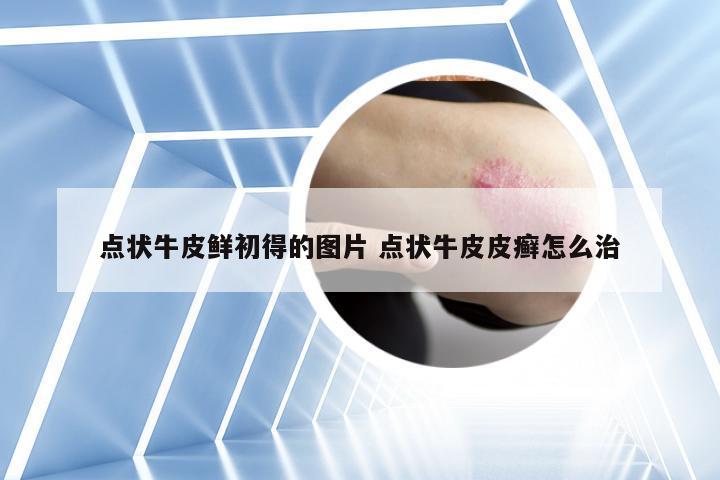 点状牛皮鲜初得的图片 点状牛皮皮癣怎么治