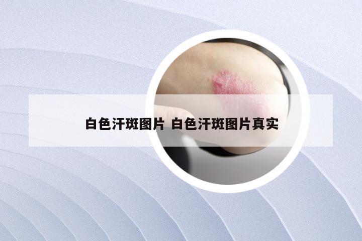 白色汗斑图片 白色汗斑图片真实