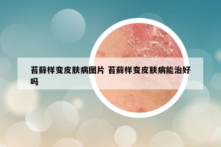 苔藓样变皮肤病图片 苔藓样变皮肤病能治好吗