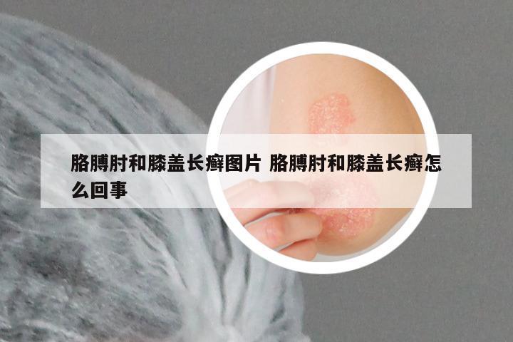 胳膊肘和膝盖长癣图片 胳膊肘和膝盖长癣怎么回事