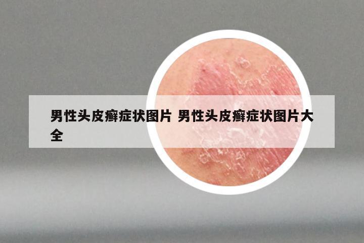 男性头皮癣症状图片 男性头皮癣症状图片大全