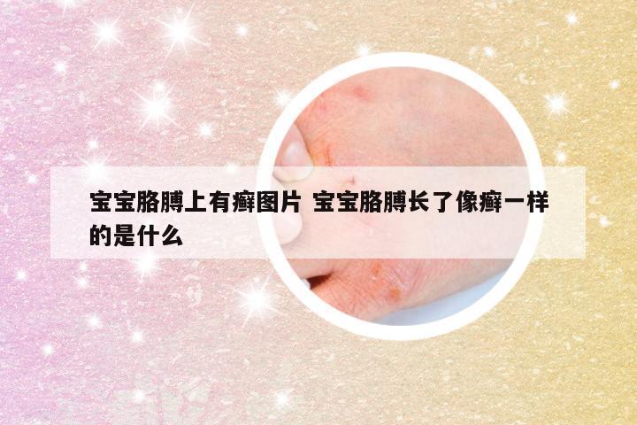 宝宝胳膊上有癣图片 宝宝胳膊长了像癣一样的是什么