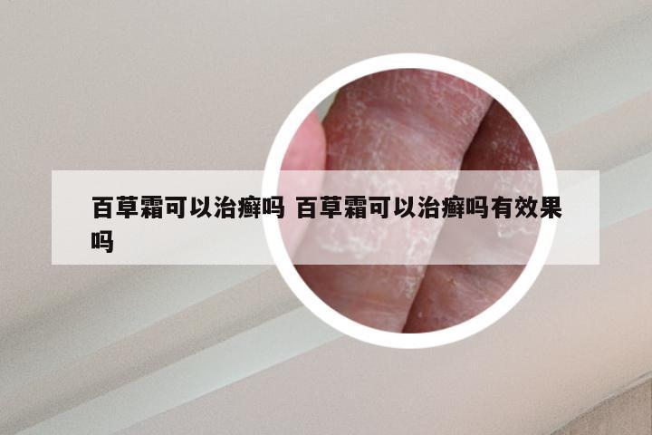 百草霜可以治癣吗 百草霜可以治癣吗有效果吗