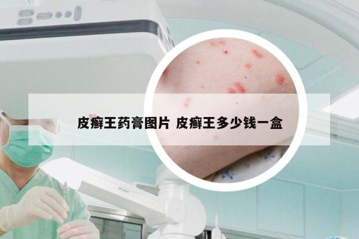 皮癣王药膏图片 皮癣王多少钱一盒