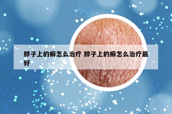 脖子上的癣怎么治疗 脖子上的癣怎么治疗最好