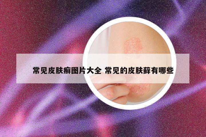常见皮肤癣图片大全 常见的皮肤藓有哪些