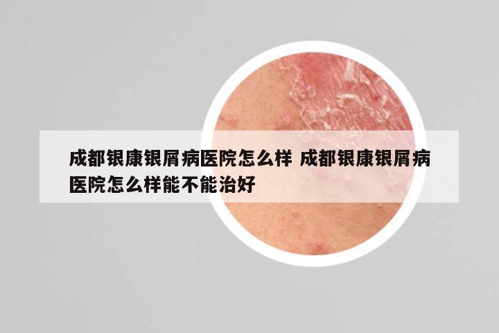 成都银康银屑病医院怎么样 成都银康银屑病医院怎么样能不能治好