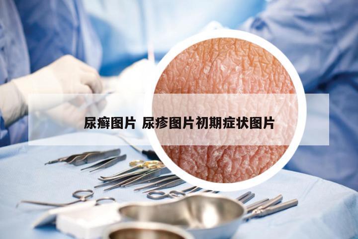 尿癣图片 尿疹图片初期症状图片