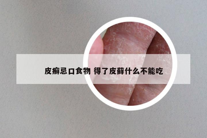 皮癣忌口食物 得了皮藓什么不能吃