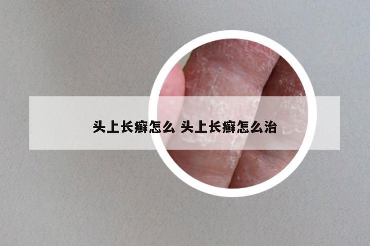 头上长癣怎么 头上长癣怎么治