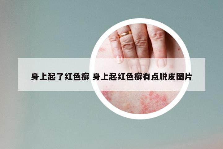 身上起了红色癣 身上起红色癣有点脱皮图片