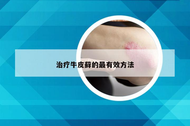 治疗牛皮藓的最有效方法