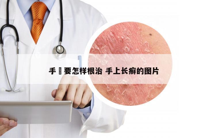 手廯要怎样根治 手上长癣的图片