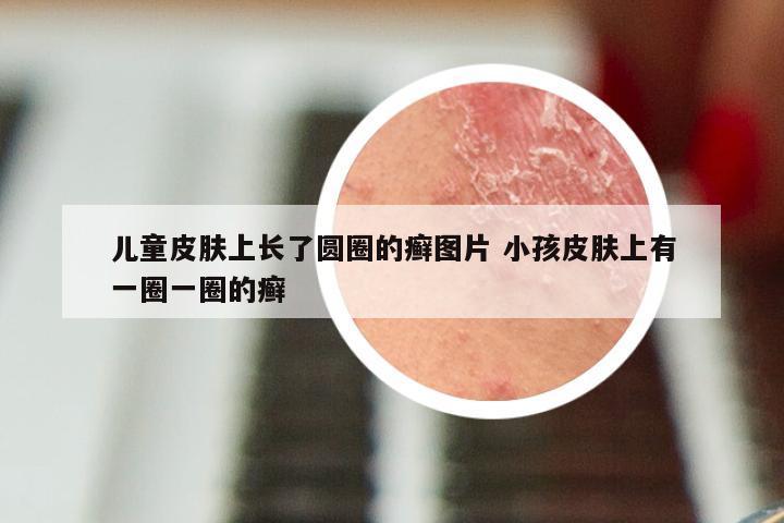 儿童皮肤上长了圆圈的癣图片 小孩皮肤上有一圈一圈的癣