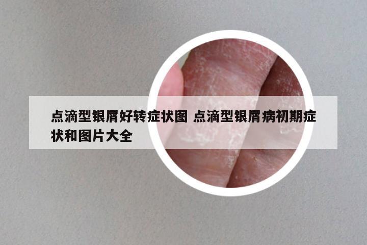 点滴型银屑好转症状图 点滴型银屑病初期症状和图片大全